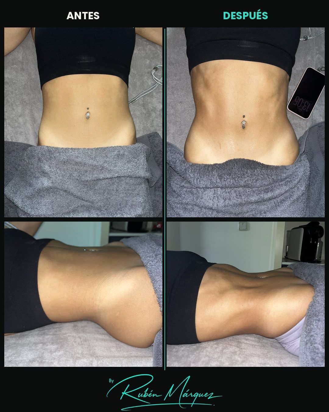 Fotos del antes y el después de un abdomen tonificado y de perfil, etiquetadas como «ANTES» y «DESPUÉS»