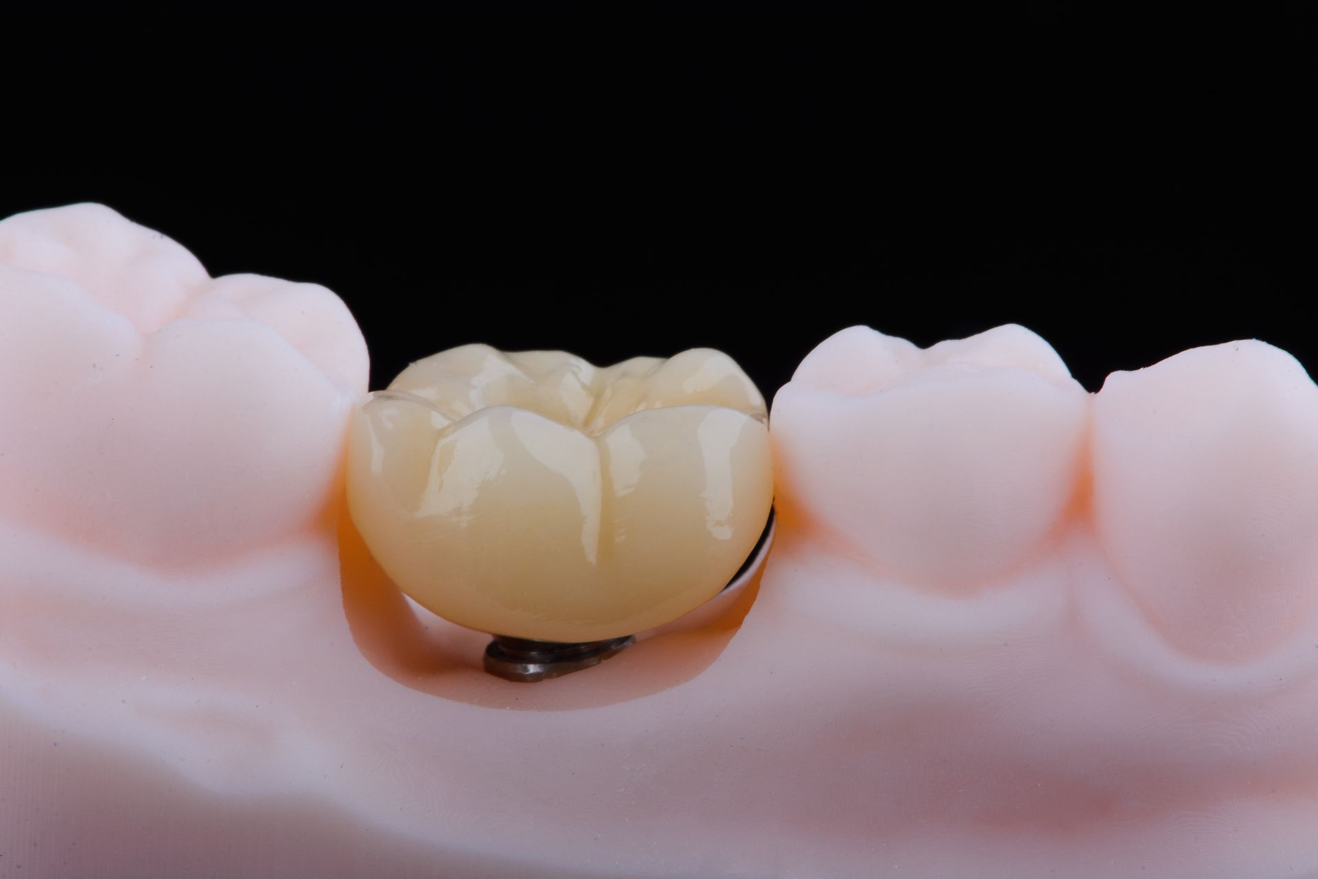 Couronne dentaire sur un modèle de molaire, représentée entre deux dents roses sur fond noir.