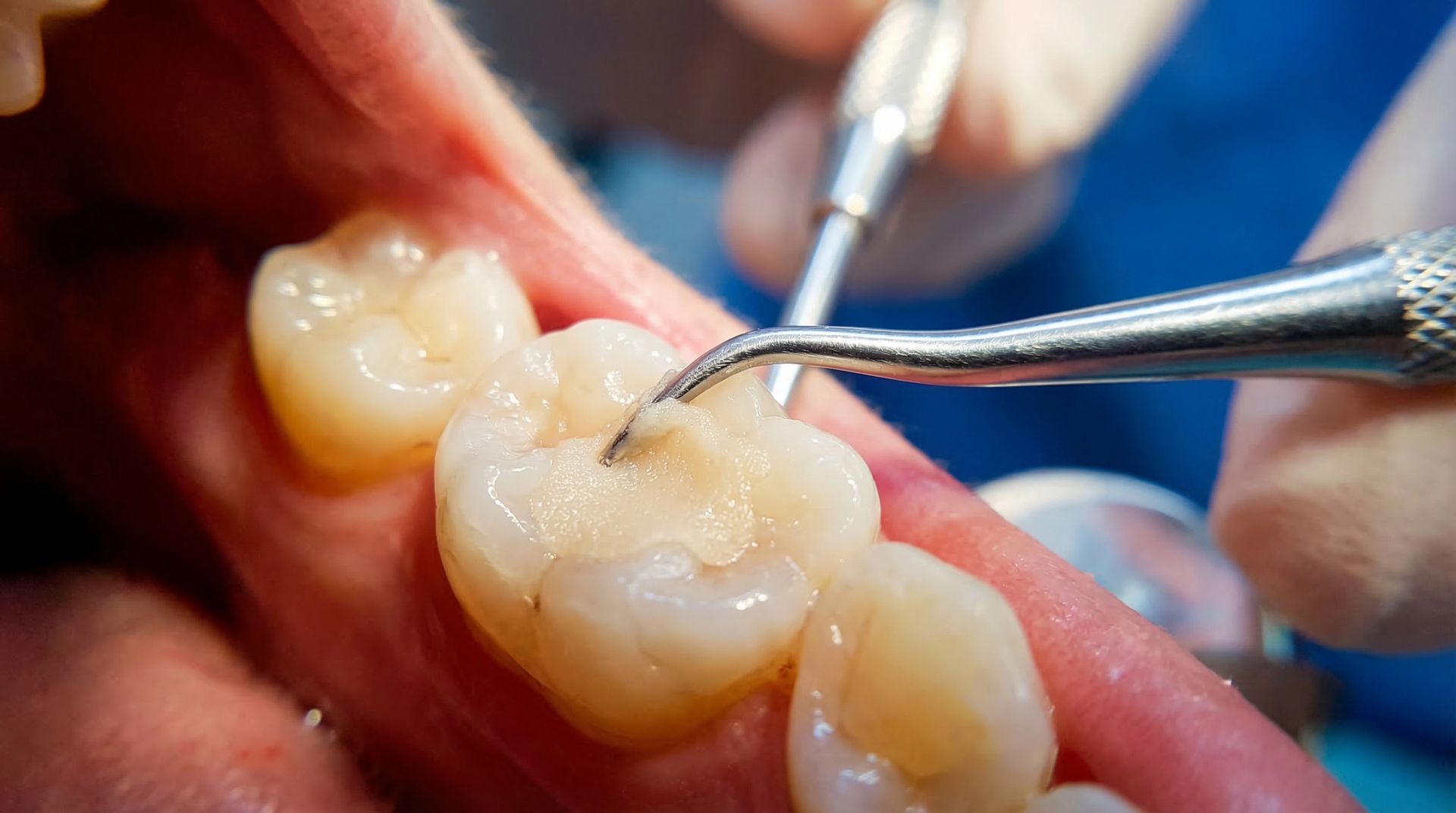 Un dentiste examine les molaires avec des instruments dentaires lors d'un contrôle.