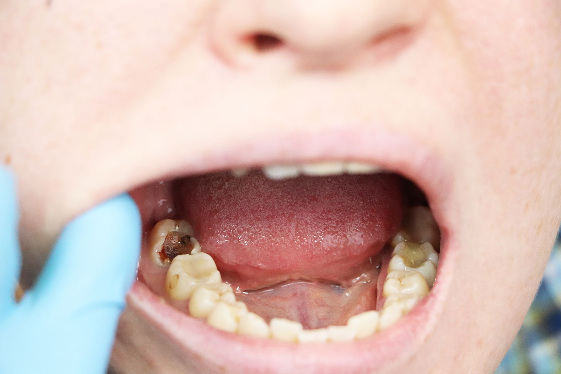 Gros plan sur une bouche ouverte montrant des dents postérieures gravement cariées, une main gantée écartant la joue.
