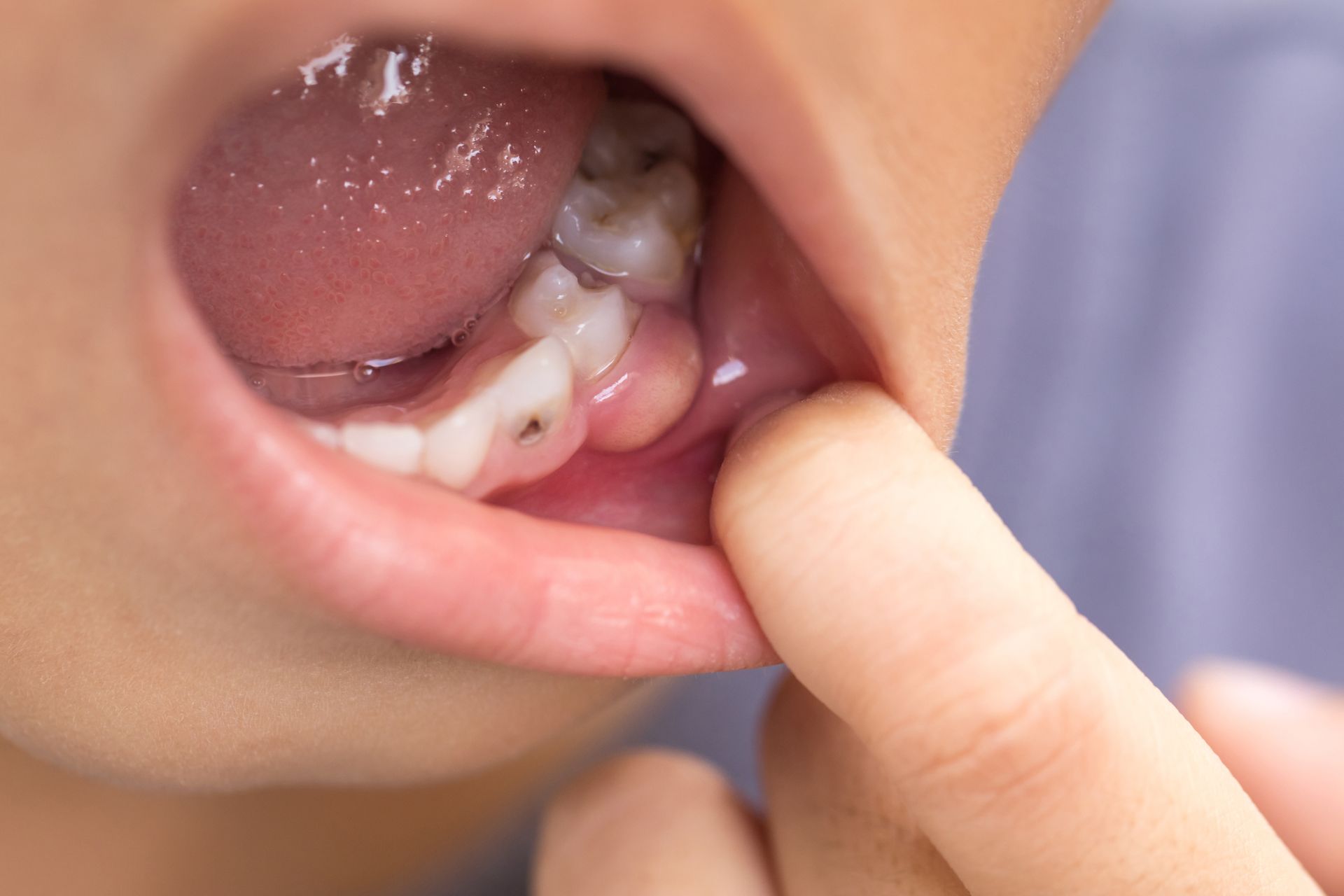 Gros plan sur la bouche ouverte d'un enfant, un doigt tirant sur sa lèvre inférieure pour montrer une molaire.