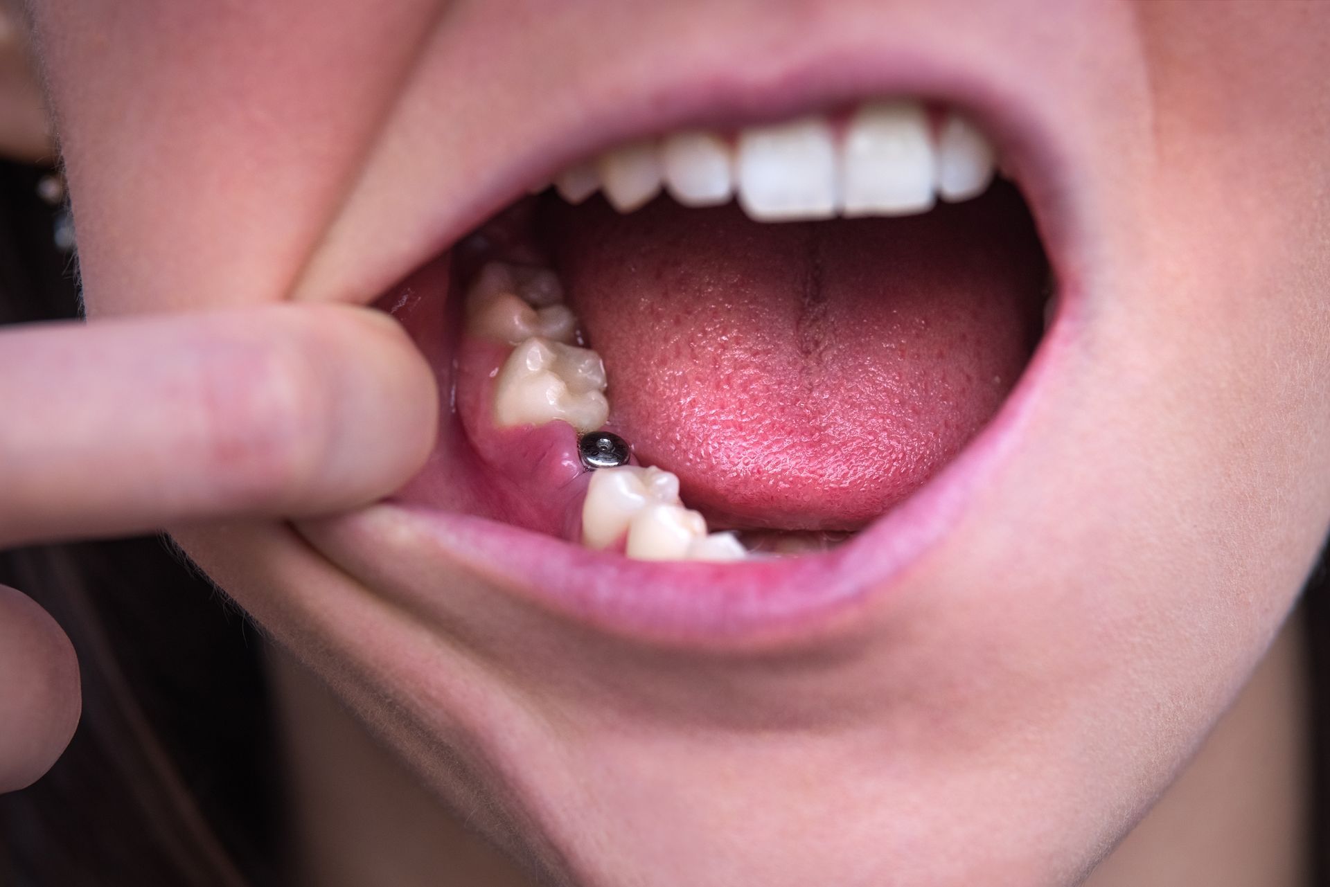 Gros plan d'une bouche ouverte, la joue écartée par un doigt, révélant les dents et la langue, ainsi qu'une carie dentaire visible.