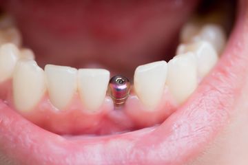 Gros plan sur les incisives inférieures avec un piercing à la langue en argent dans la bouche
