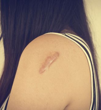 Un primer plano del hombro de una mujer con una cicatriz.
