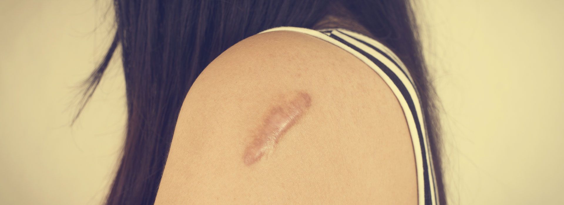 Un primer plano del hombro de una mujer con una cicatriz.
