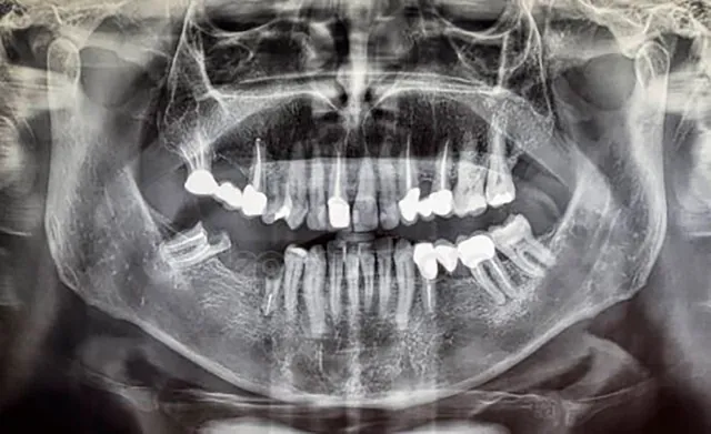 Una radiografía panorámica de los dientes y el cráneo de una persona.