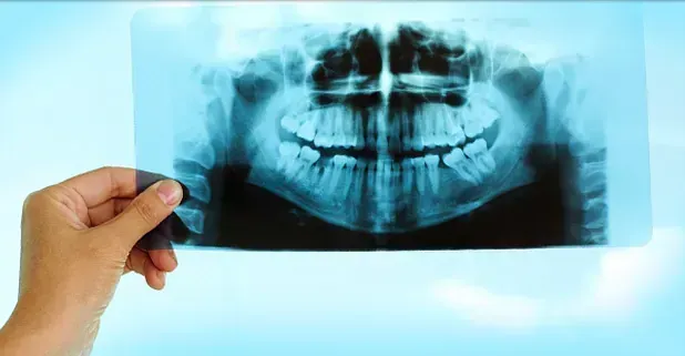 Una persona sostiene una radiografía de los dientes de una persona.