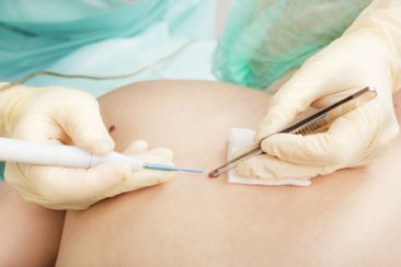 Arzt entfernt ein Muttermal bei einem Patienten