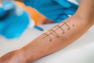 Allergietest auf dem Arm eines Patienten