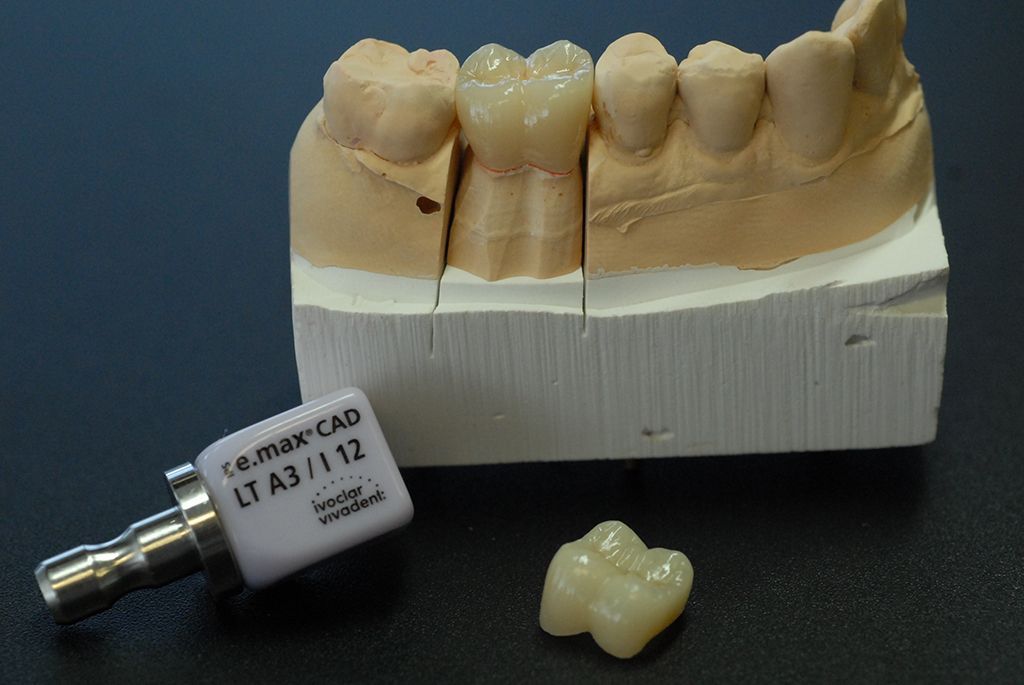 Vollkeramikkrone - Hauser Zahntechnik GmbH - Gunzgen