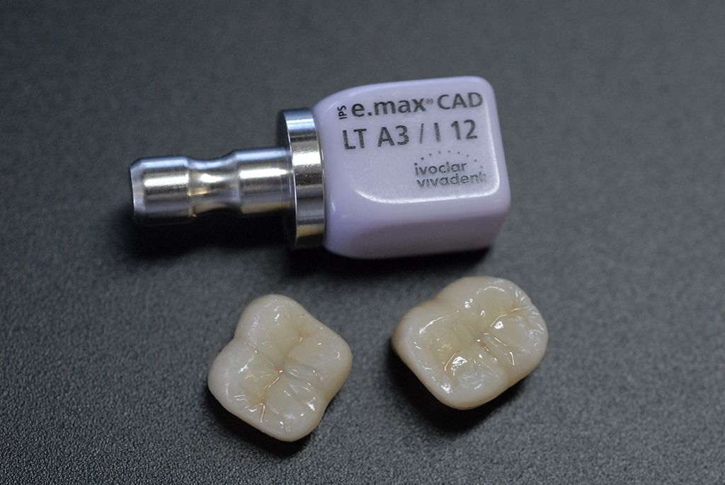 e.max Kronen - Hauser Zahntechnik GmbH - Gunzgen