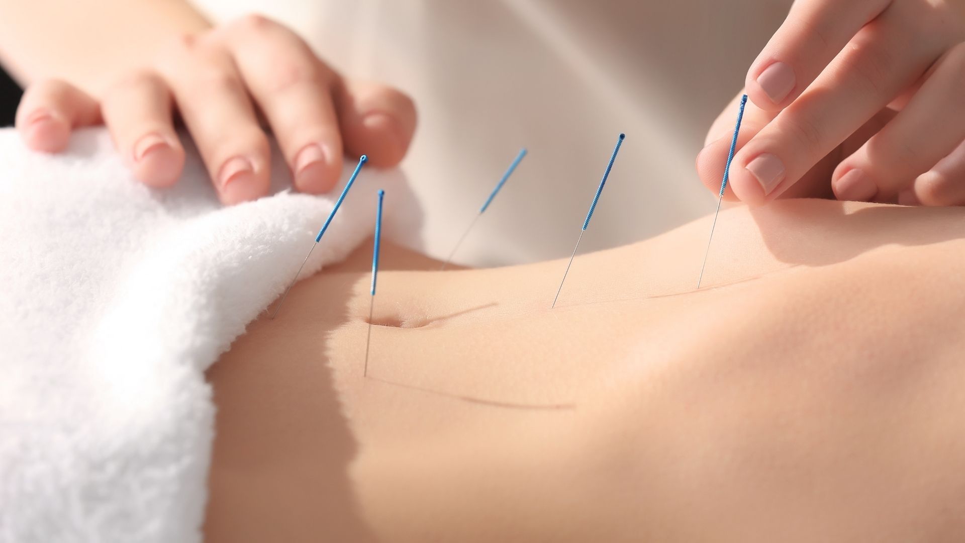 Una persona recibe tratamiento de acupuntura en el abdomen; se insertan agujas finas en la piel.