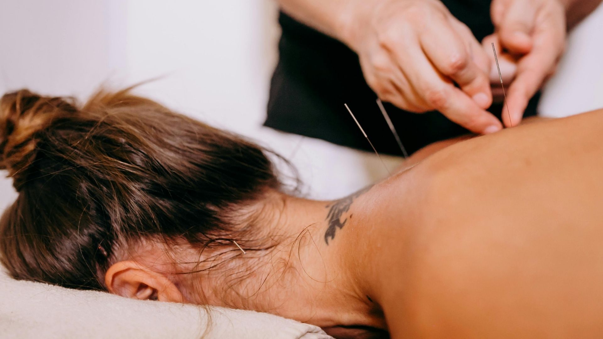 Una persona que recibe acupuntura en la parte superior de la espalda, con agujas insertadas.