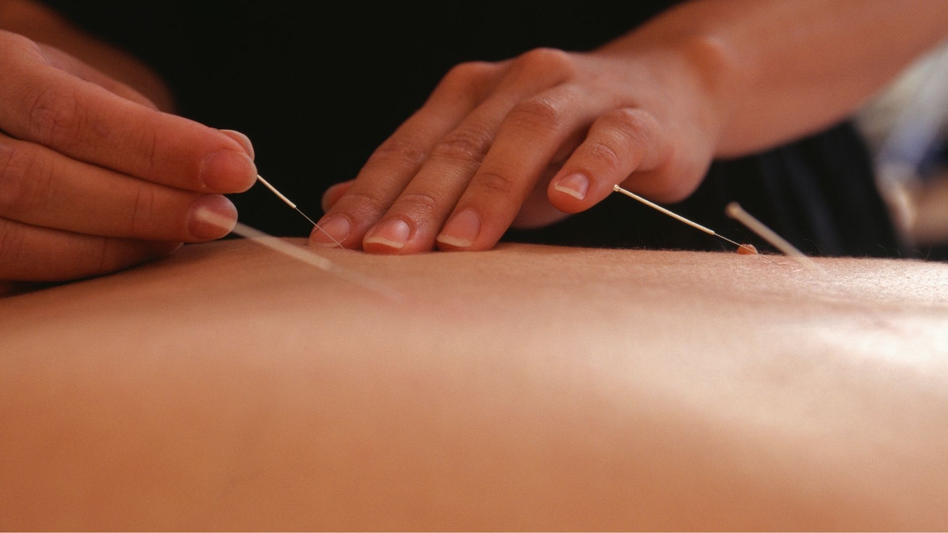Manos insertando agujas de acupuntura en la espalda de una persona.