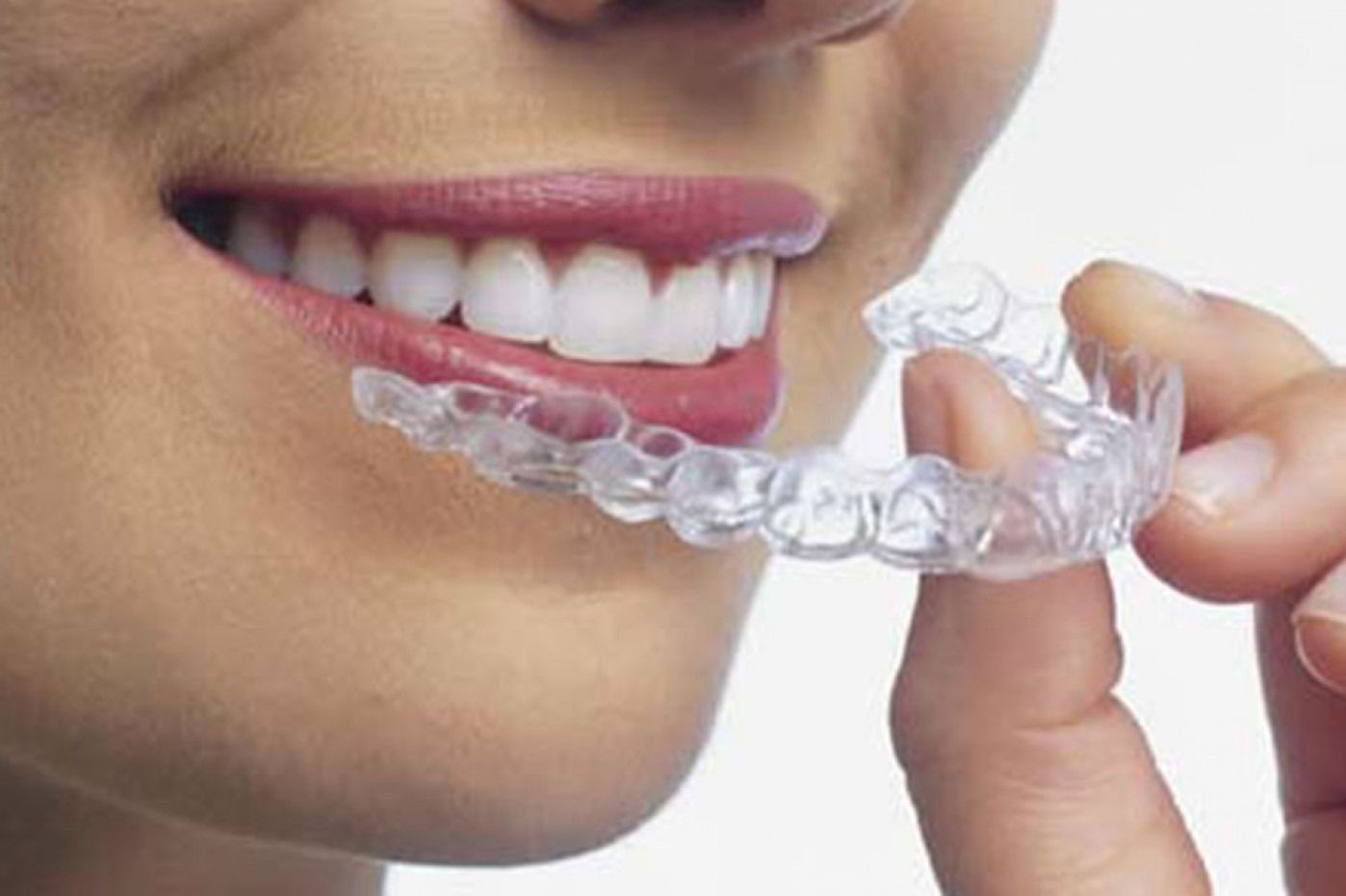 Persona che indossa gli allineatori trasparenti.