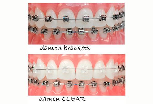Una imagen de los dientes de una persona con brackets Damon y brackets transparentes Damon.