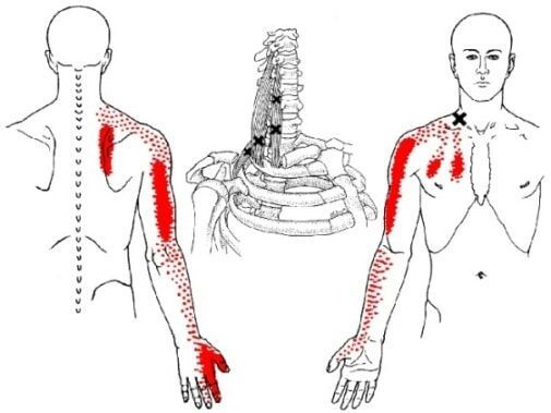 Trigger points
