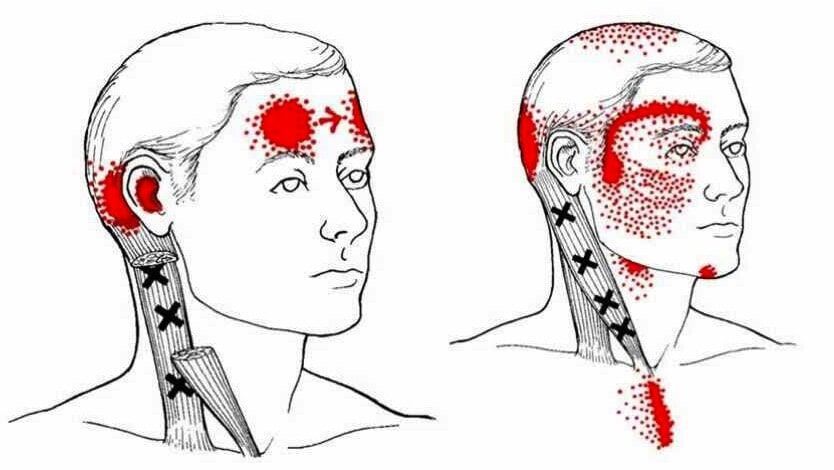 Trigger points