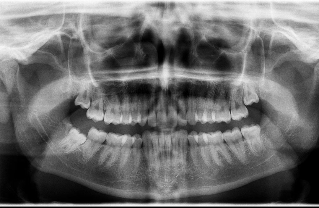 Una radiografía panorámica de los dientes y el cráneo de una persona.