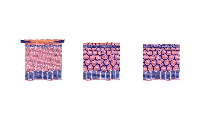 Dermazeutische Fruchtsäure - Haut Grafiken
