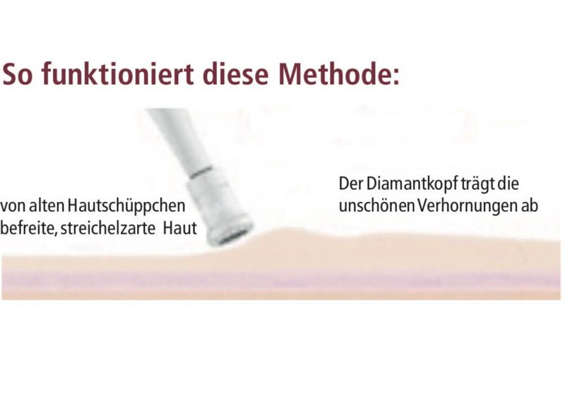 Diamant Mikrodermabrasion - So funltioniert die Methode