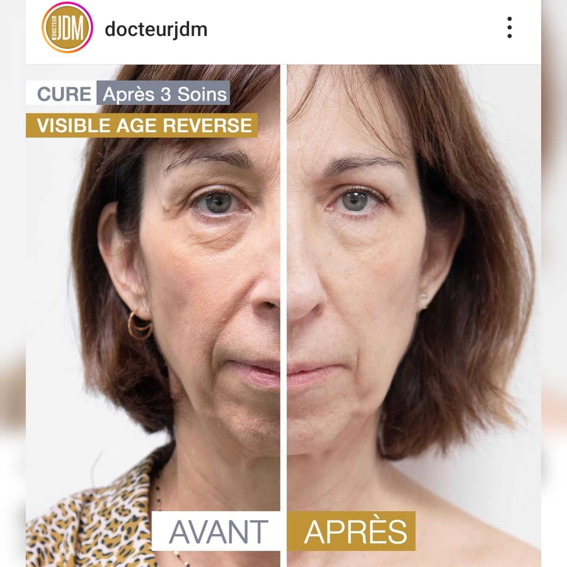 Avant et après d'un visage avec le traitement Age Reverse de Docteur JDM