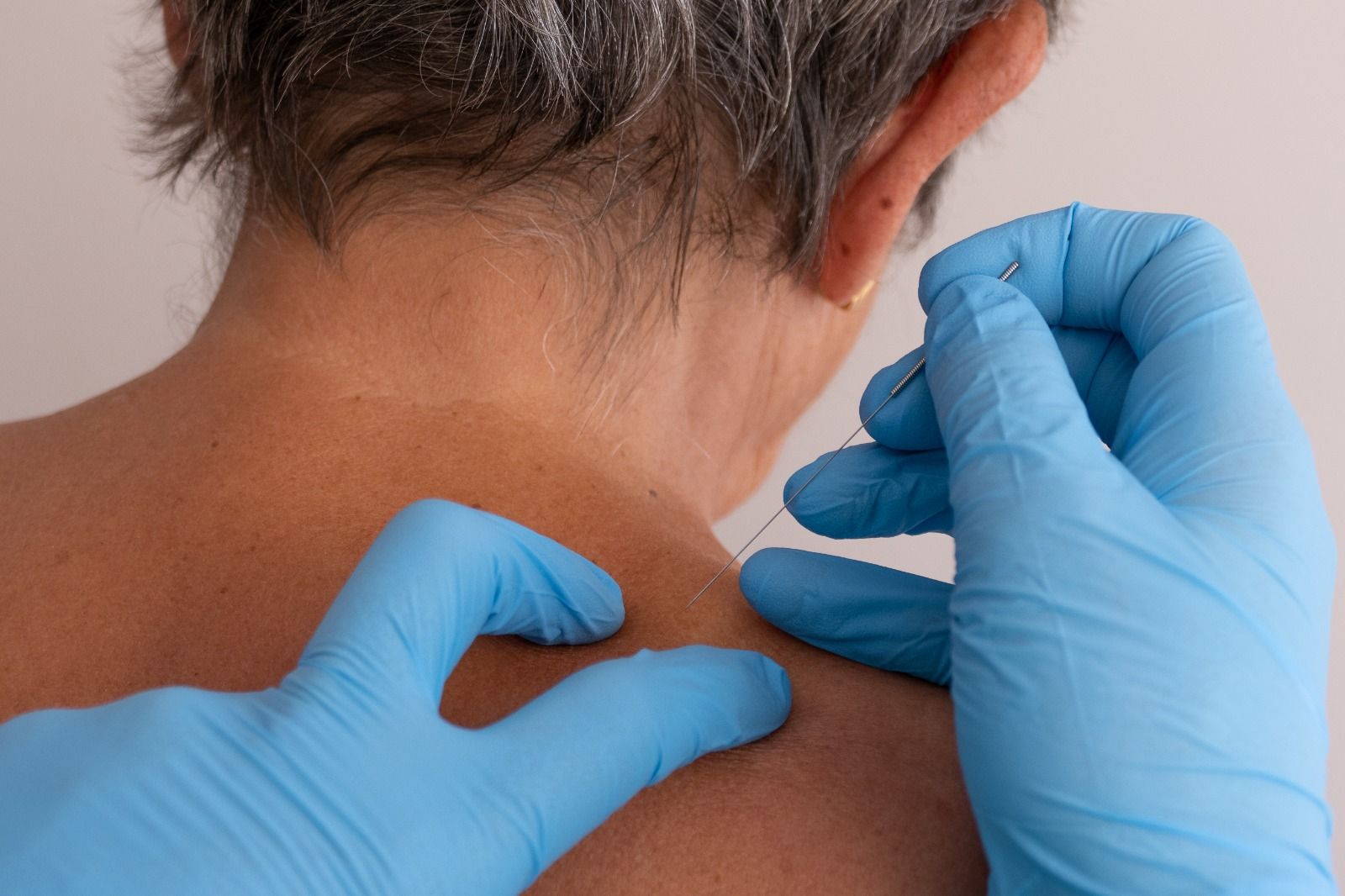 Una persona está recibiendo un tratamiento de acupuntura en la espalda.