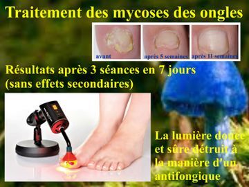 Traitement des mycoses des ongles pieds avec une lumière douce