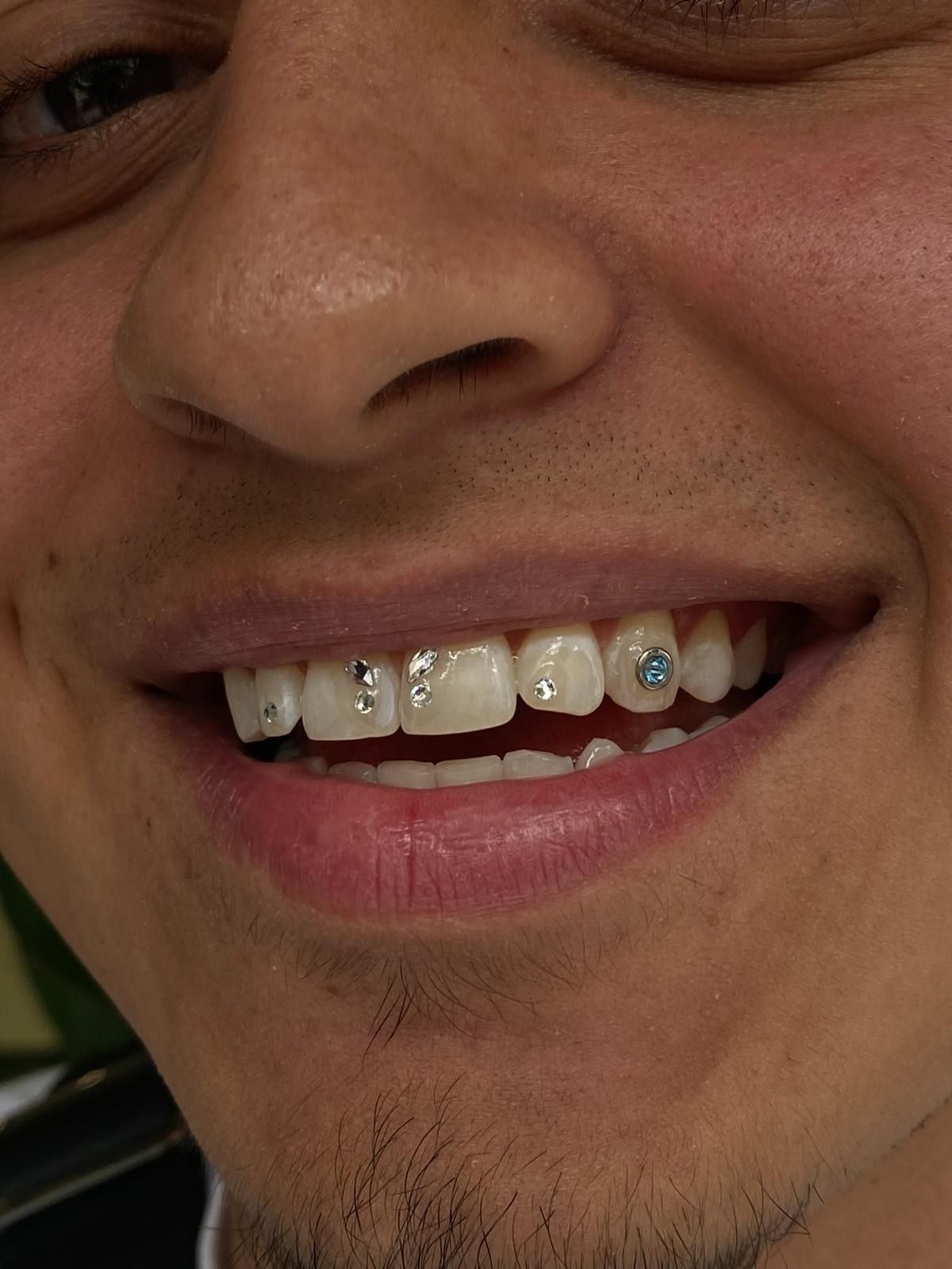 Primer plano de una persona sonriendo, mostrando dientes con múltiples gemas brillantes adheridas.