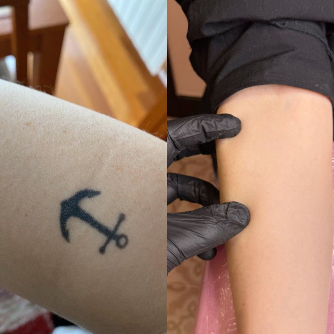 Dos imágenes una al lado de la otra: un tatuaje de ancla negro en un brazo y el mismo brazo sin el tatuaje.