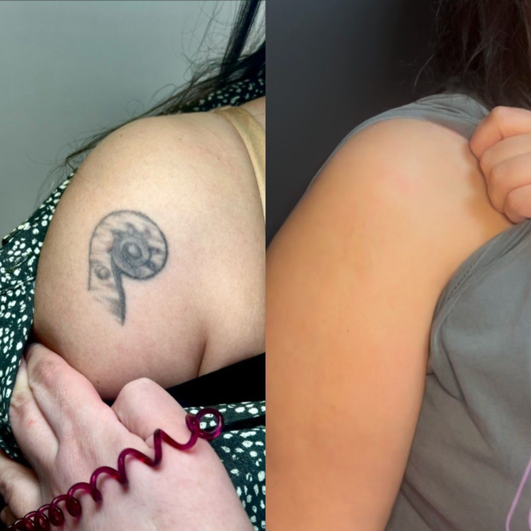 Progreso de la eliminación de un tatuaje: brazo con un tatuaje negro descolorido (izquierda) hasta piel limpia (derecha).