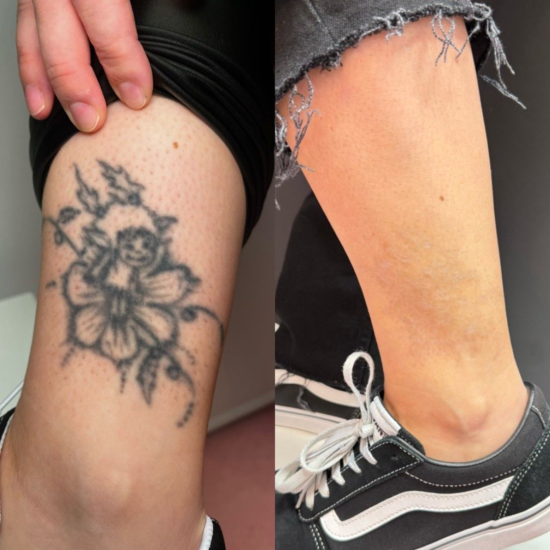 Tatuaje en el tobillo antes y después de la eliminación con láser: el diseño de flores negras se desvanece en piel clara.
