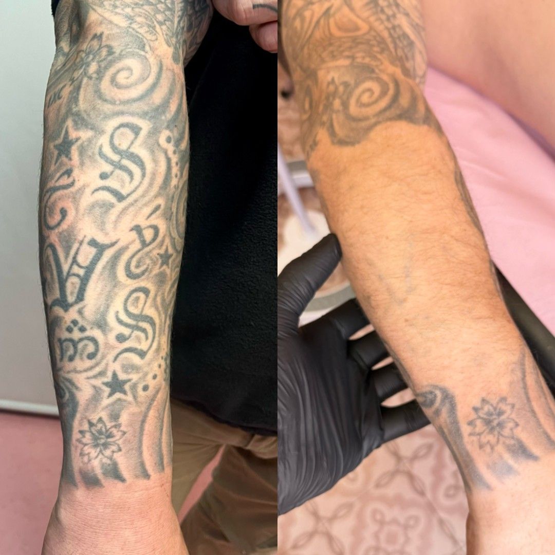 Comparación: Brazo izquierdo con tatuaje descolorido, brazo derecho con tatuaje casi eliminado.