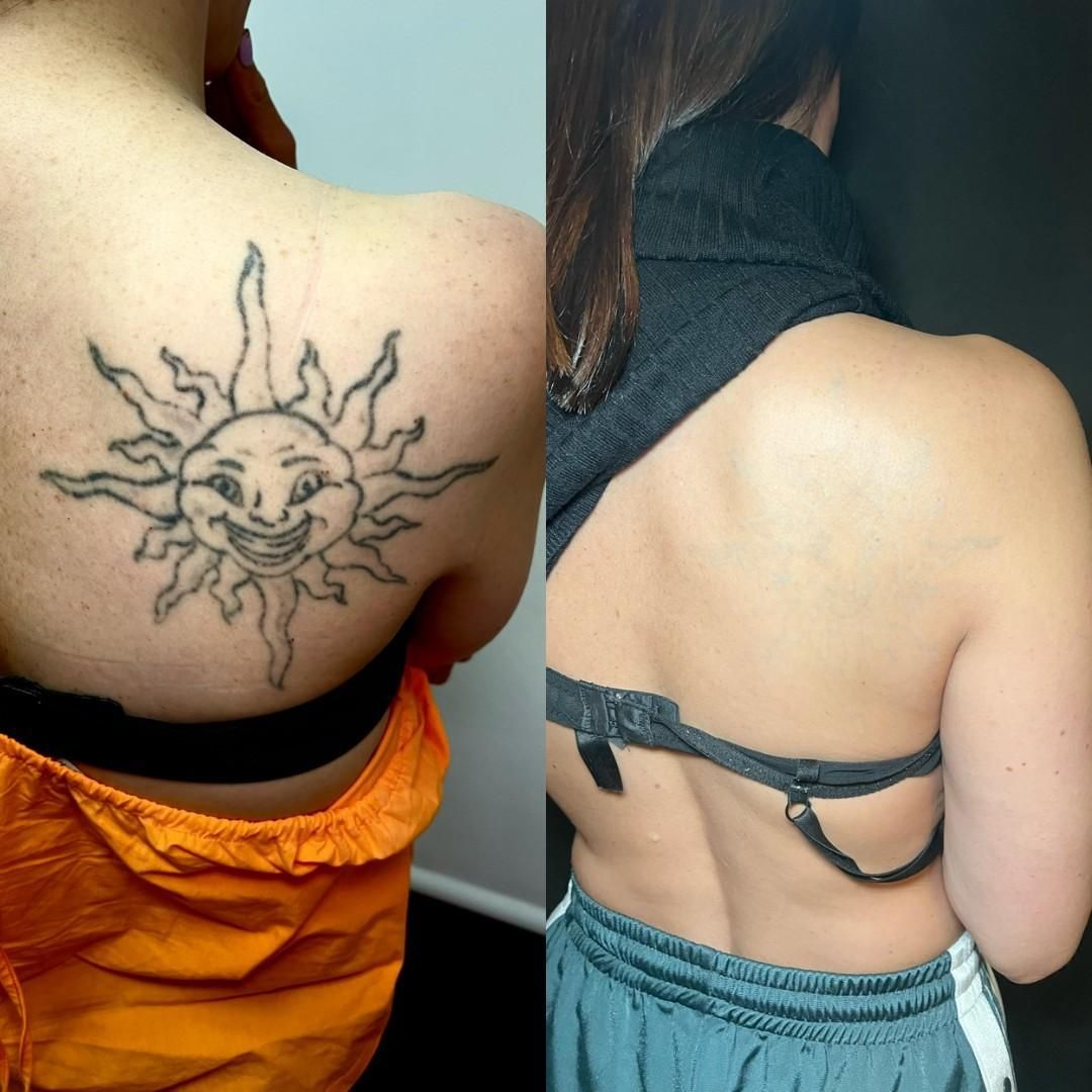 Comparación: Tatuaje del sol en la espalda, luego eliminación del tatuaje, revelando una piel clara.