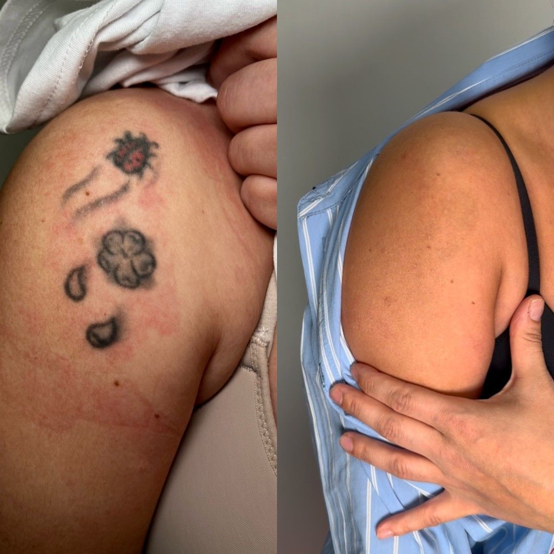 Comparación de un hombro con un tatuaje descolorido antes y después de eliminarlo, mostrando una piel más suave.
