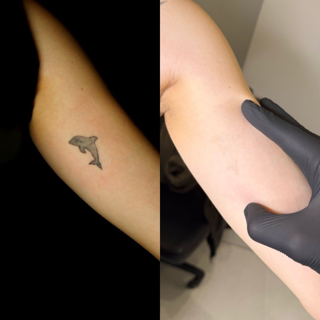 Izquierda: Brazo con tatuaje de delfín. Derecha: Mismo brazo, sin tatuaje, mano con guante negro.