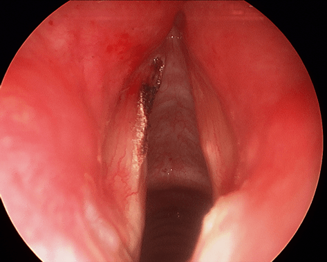 Laser larynx ORL TOURS