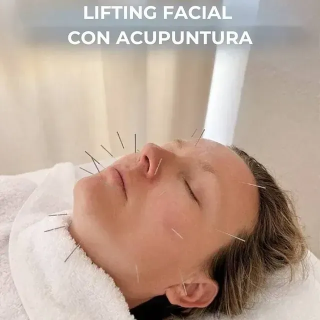 Una persona con agujas de acupuntura en la cara recibe un tratamiento facial. El texto superior dice 