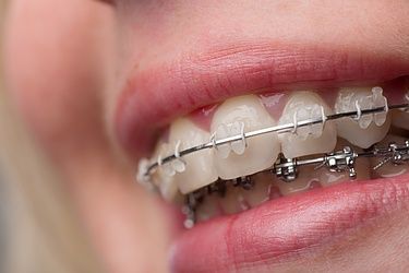 Orthodontie - Cabinet dentaire Freesia Alba - Lausanne