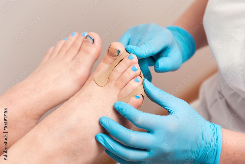 Des mains gantées de bleu appliquent un séparateur d'orteils sur un pied dont les ongles sont vernis en bleu.
