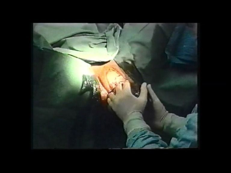 Manos con guantes quirúrgicos realizando un procedimiento en un paciente en un entorno hospitalario.