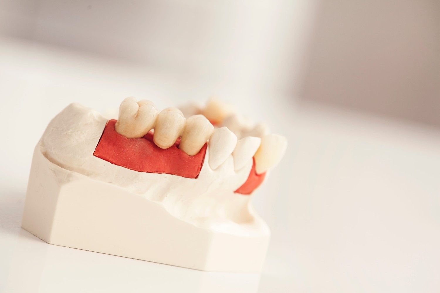 Modelo dental con dientes blancos y encías rojas sobre un fondo blanco.