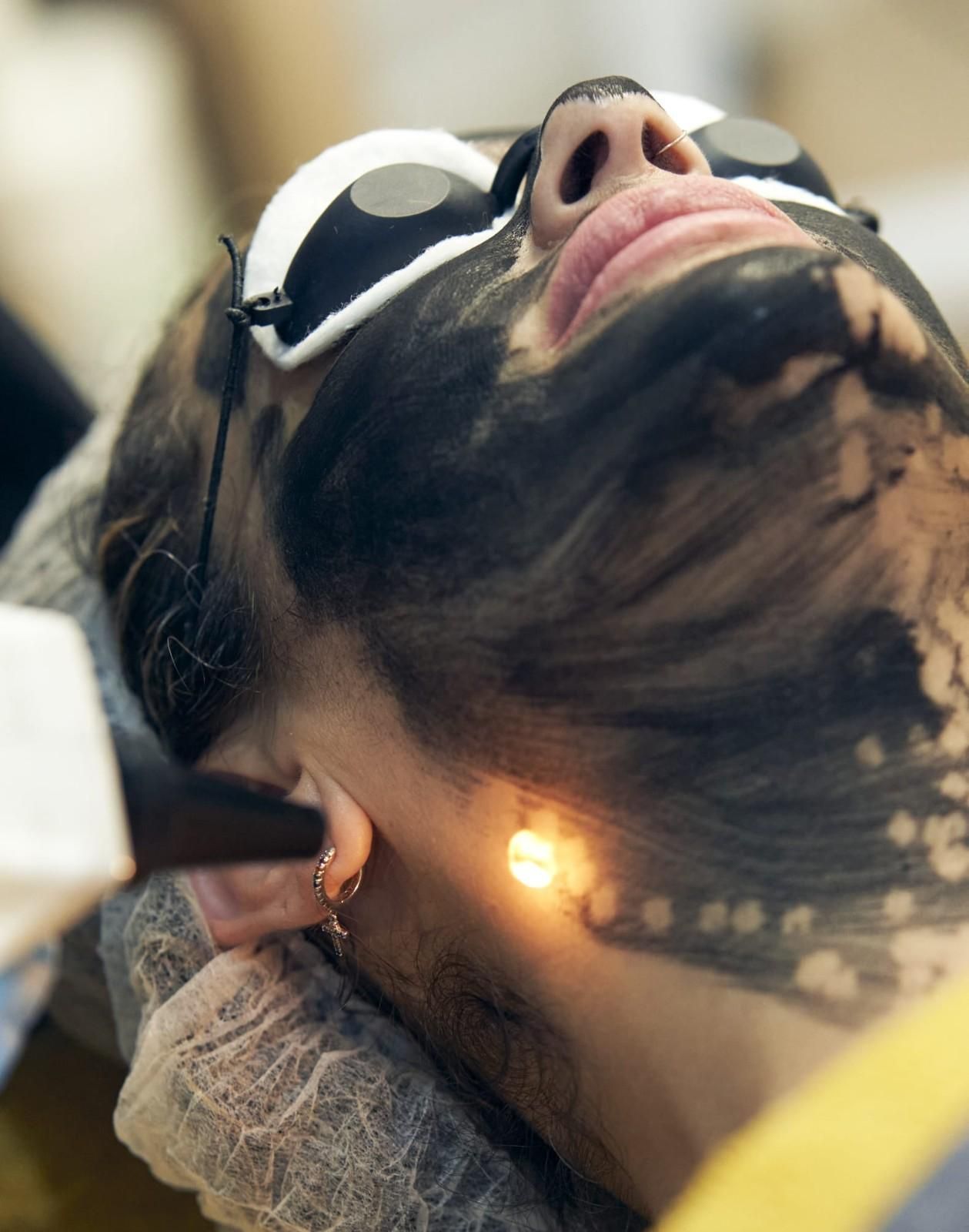 Persona sometida a un peeling láser de carbono; máscara oscura en la cara, luz láser en la mejilla.