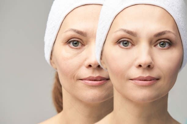 Uma foto de antes e depois do rosto de uma mulher com uma toalha na cabeça.