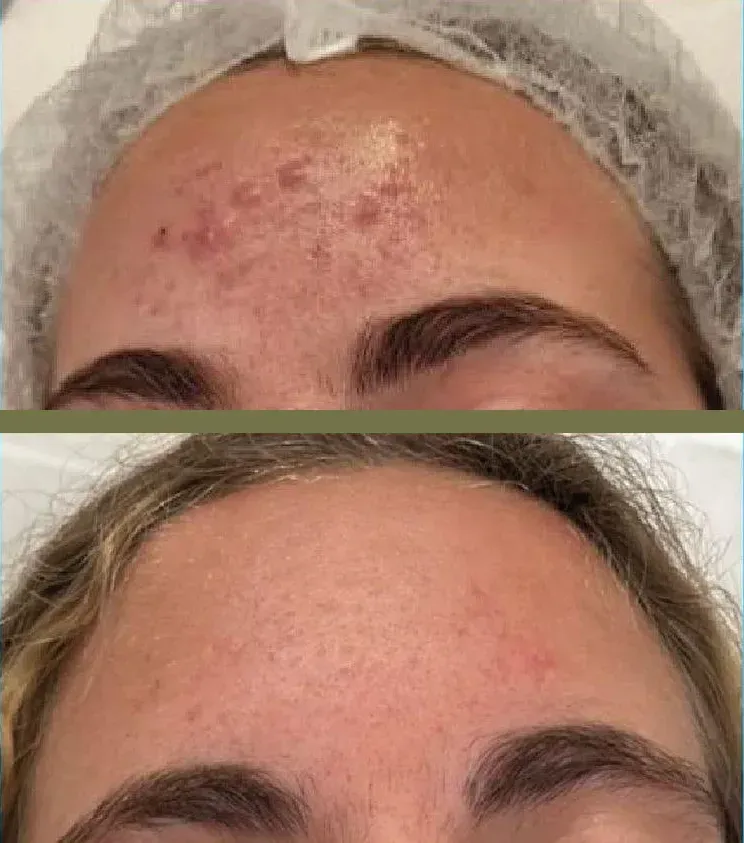 Arriba: Acné en la frente. Abajo: Frente despejada. Antes y después del tratamiento.
