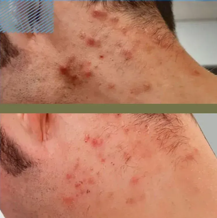 Primer plano del cuello de una persona con acné visible. La piel está rojiza, con algunas imperfecciones más oscuras.