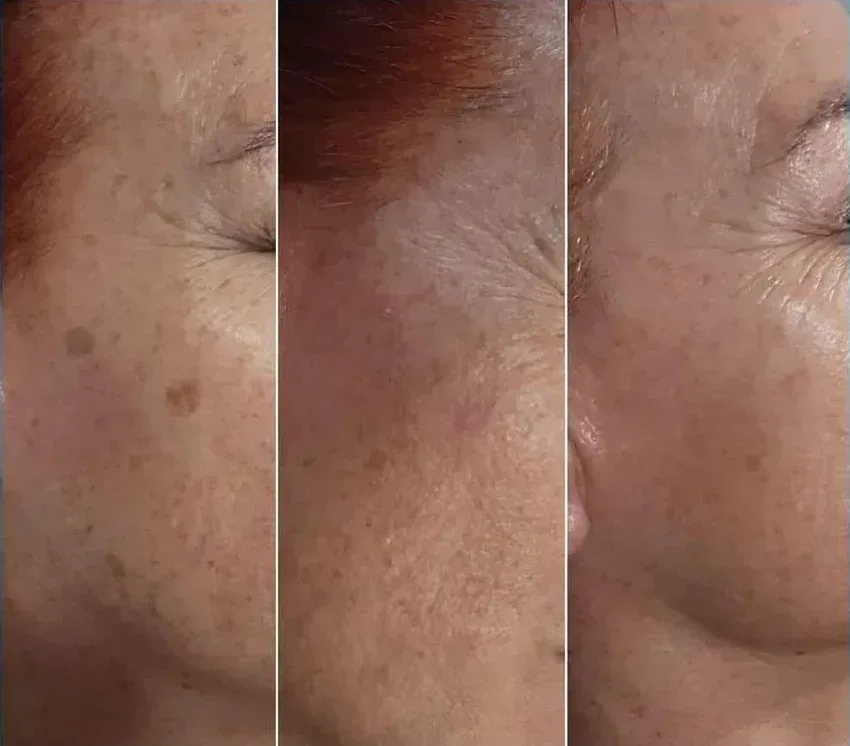 Tres paneles de un rostro que muestran la reducción de manchas y arrugas causadas por la edad.