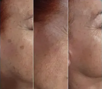 Tres paneles de un rostro que muestran la reducción de manchas y arrugas causadas por la edad.
