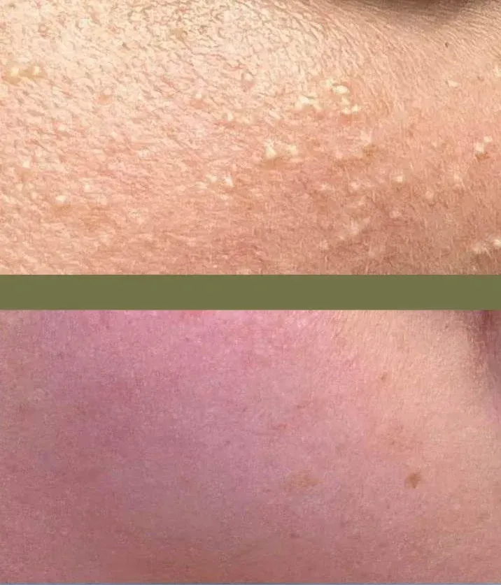 Piel antes y después del tratamiento, mostrando una textura irregular que se suaviza.
