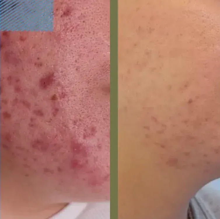 Vista antes y después de la piel con acné: izquierda, acné inflamado; derecha, mejorado con menos acné.